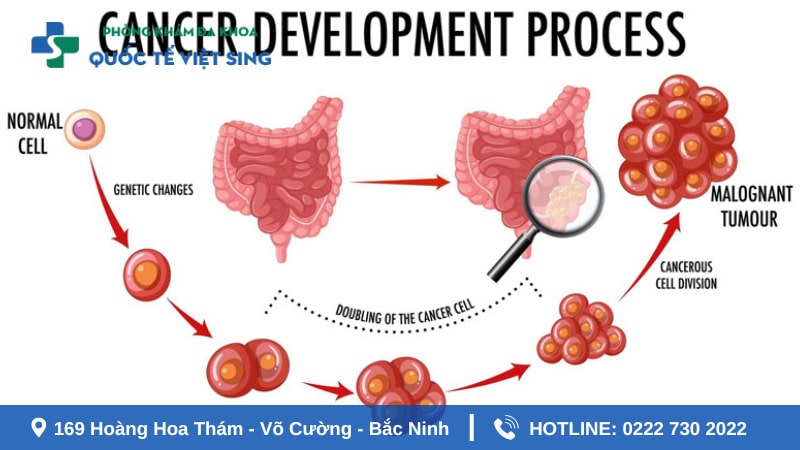 Ung thư đại trang - đại tiện ra máu