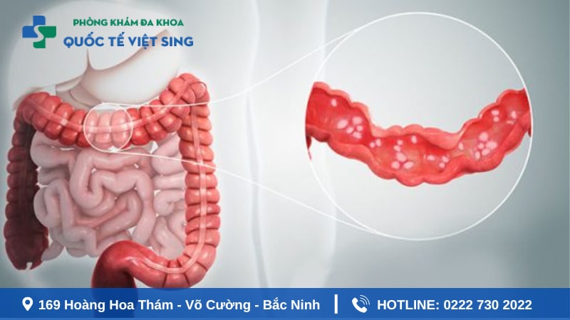 Viêm loét đại trực tràng