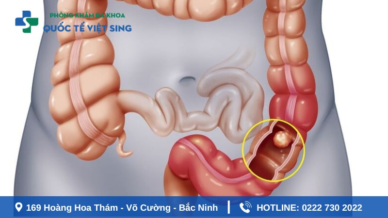 Viêm túi thừa – Nguy cơ gây đại tiện ra máu
