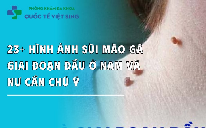 https://dakhoaquoctebacninh.com/wp-content/uploads/2025/07/23-hinh-anh-sui-mao-ga-giai-doan-dau-o-nam-va-nu.jpg