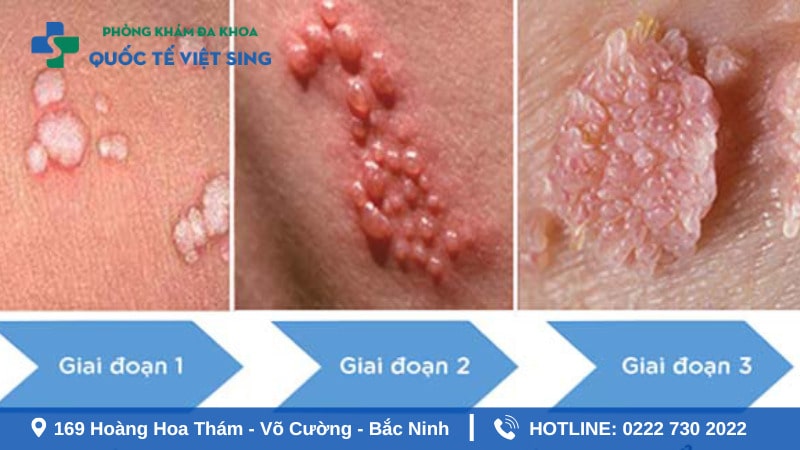 Các giai đoạn phát triển của sùi mào gà sau thời gian ủ bệnh