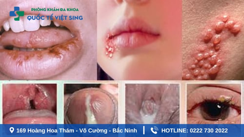 Bệnh lậu là gì? Tại sao cần điều trị sớm