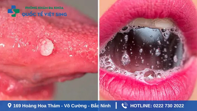 Bệnh sùi mào gà có lây qua nước bọt không?