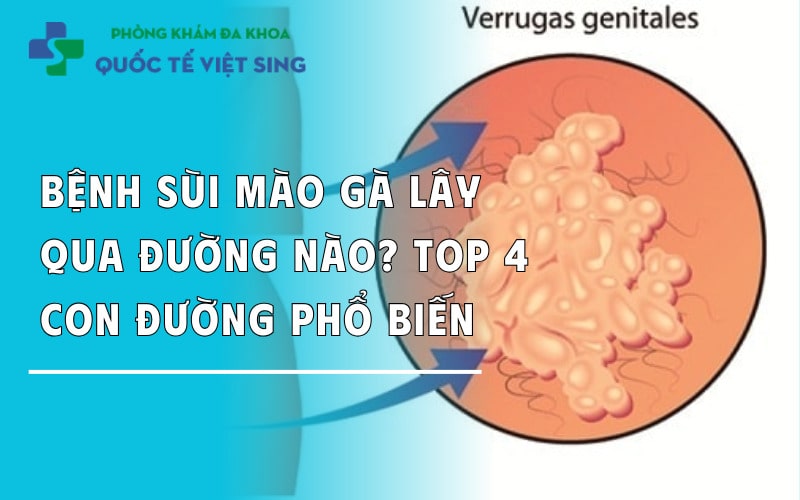 Bệnh sùi mào gà lây qua đường nào? 4 con đường bạn cần tránh