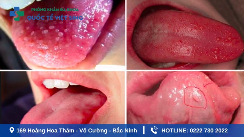Bị sùi mào gà qua đường nước bọt có nguy hiểm không?