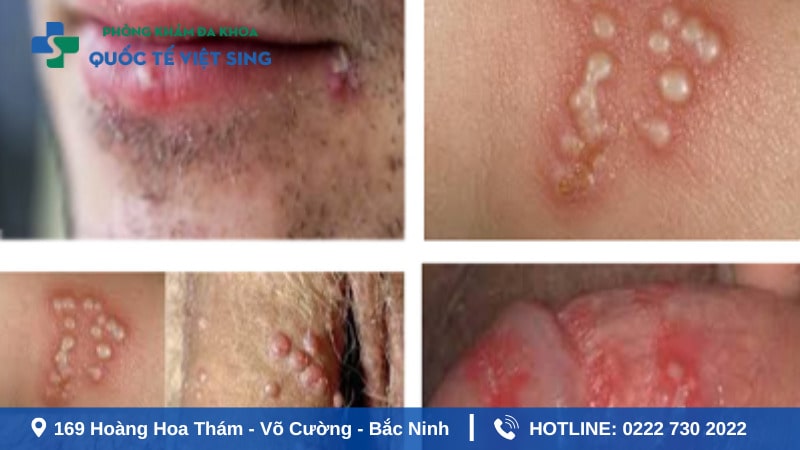 Sùi mào gà biểu hiện ban đầu như thế nào?