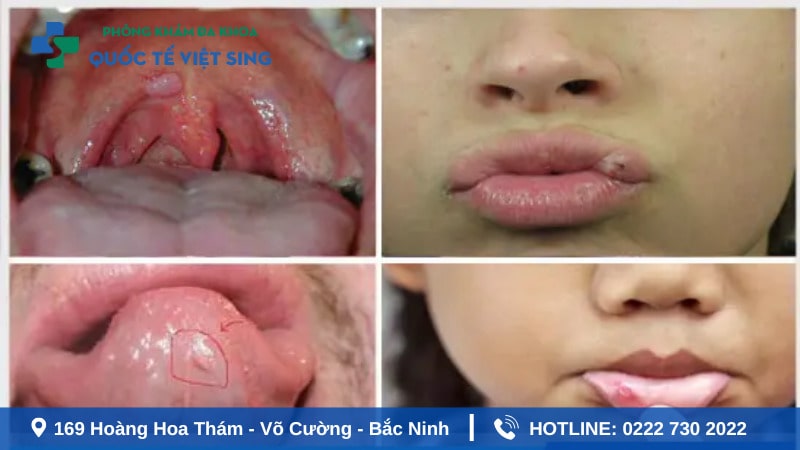 Hình ảnh sùi mào gà tại các trị trí khác