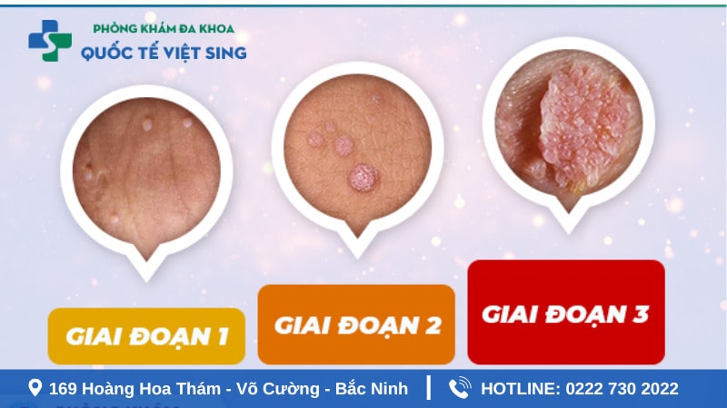 Các giai đoạn phát triển sùi mào gà ở nam giới