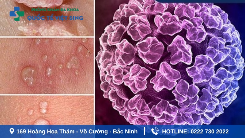 Nguyên nhân và con đường lây nhiễm sùi mào gà