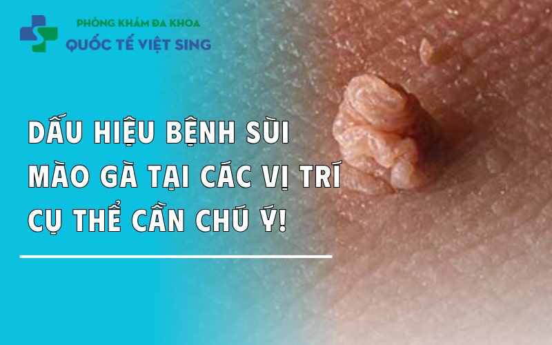 Dấu hiệu bệnh sùi mào gà xuất hiện ở các vị trí cụ thể cần chú ý!