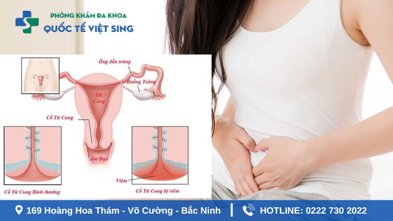 Dấu hiệu nhận biết bệnh sùi mào gà ở nữ giai đoạn đầu 