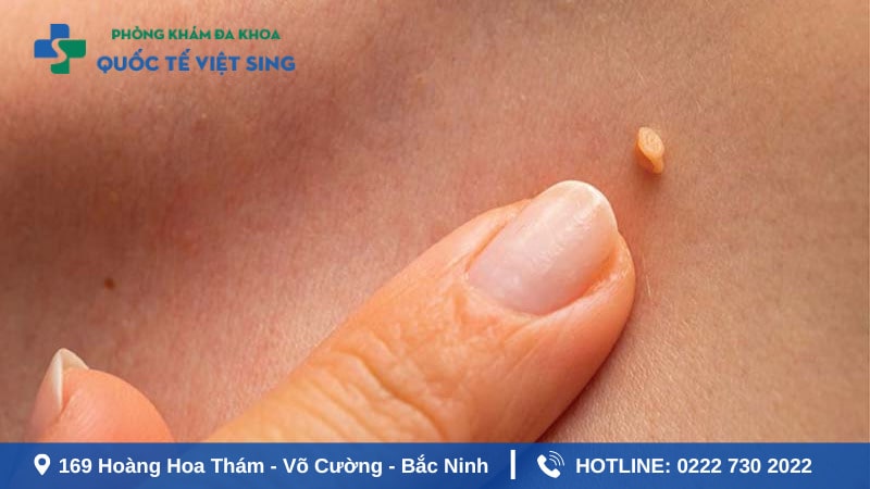 Dấu hiệu nhận biết sùi mào gà ở giai đoạn ủ bệnh