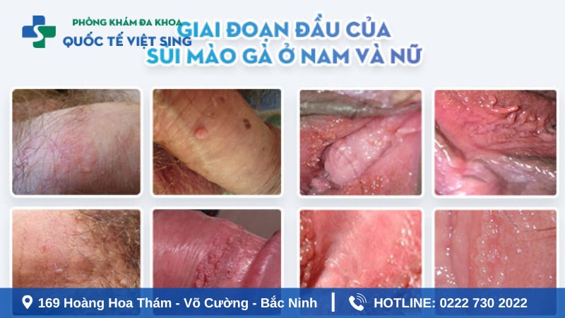Dấu hiệu sùi mào gà ở nam và nữ trong giai đoạn đầu