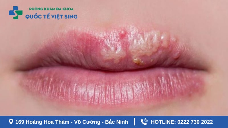 Dấu hiệu sùi mào gà ở môi