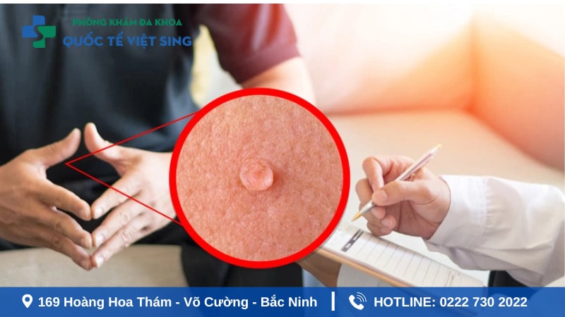 Nhận biết dấu hiệu sùi mào gà ở nam giới giai đoạn đầu