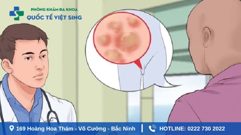 Điều trị sùi mào gà giai đoạn đầu ở nam hiệu quả