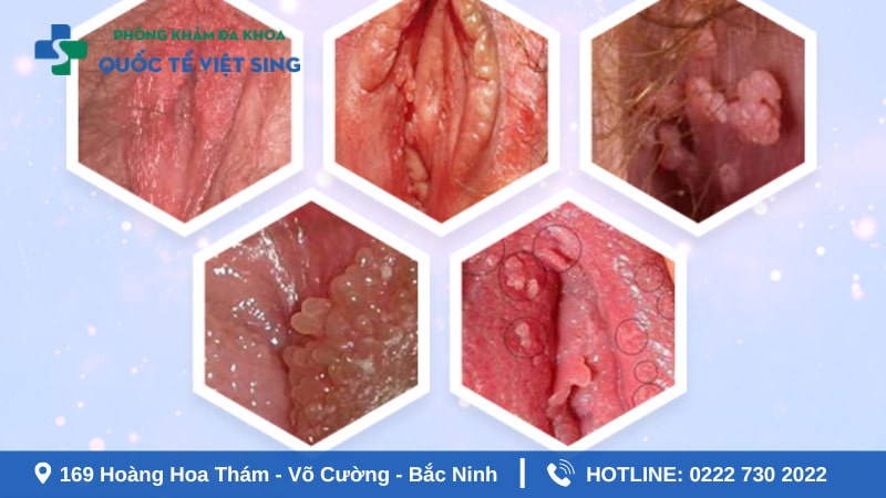 hình ảnh sùi mào gà giai đoạn đầu ở nữ tại vùng kín