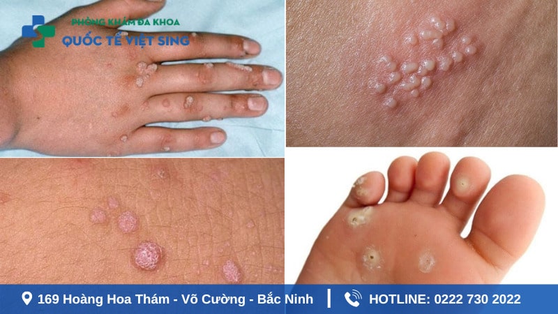 Hình ảnh sùi mào gà giai đoạn đầu ở chân tay và trên da