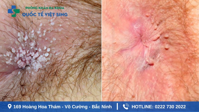 Hình ảnh sùi mào gà giai đoạn đầu ở hậu môn
