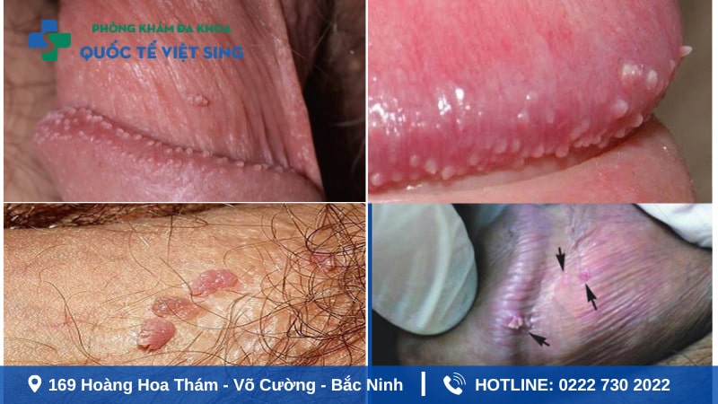 Hình ảnh sùi mào gà giai đoạn đầu ở vùng kín nam giới