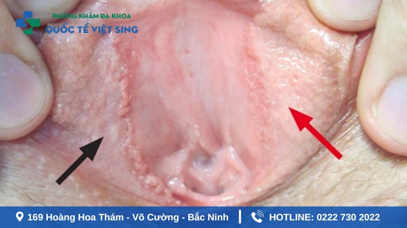 Hình ảnh sùi mào gà ở bộ phận sinh dục nữ