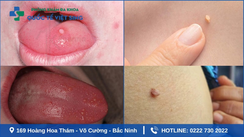 hình ảnh sùi mào gà giai đoạn đầu ở nữ tại miệng, lưỡi và da