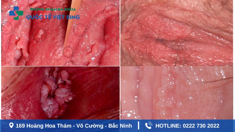 hình ảnh sùi mào gà giai đoạn đầu ở vùng kín nữ giới