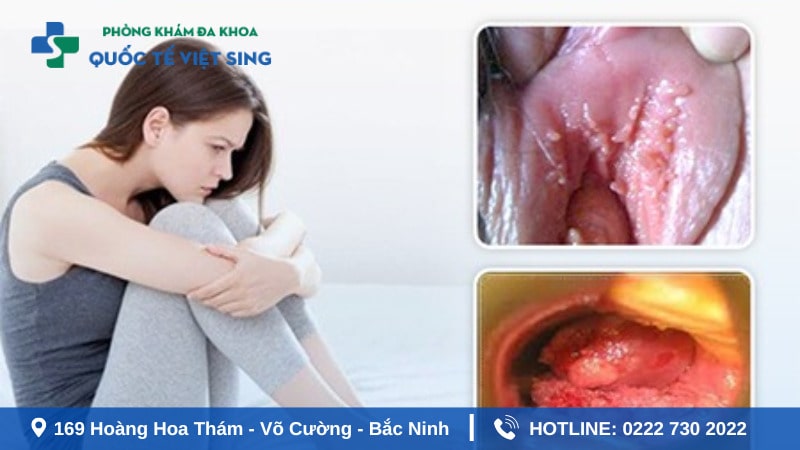 Dấu hiệu bệnh sùi mào gà xuất hiện ở nữ