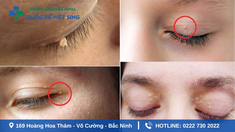Hình ảnh sùi mào gà giai đoạn đầu ở mắt