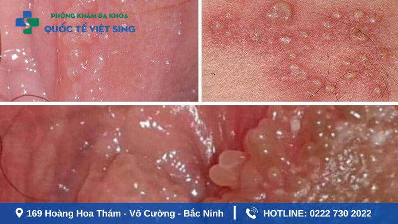 Bệnh sùi mào gà giai đoạn đầu có nguy hiểm không?
