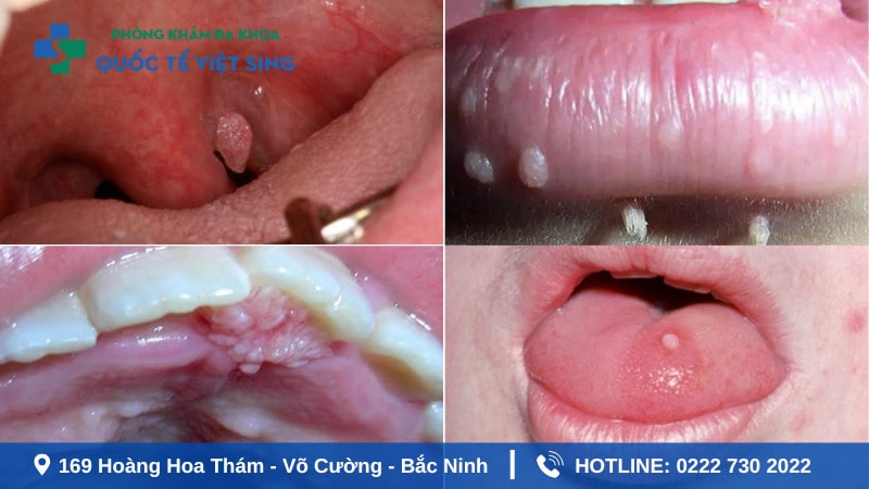 Hình ảnh sùi mào gà giai đoạn đầu ở miệng, lưỡi và họng