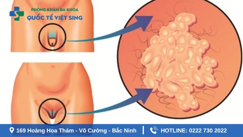 Đôi nét về sùi mào gà giai đoạn đầu