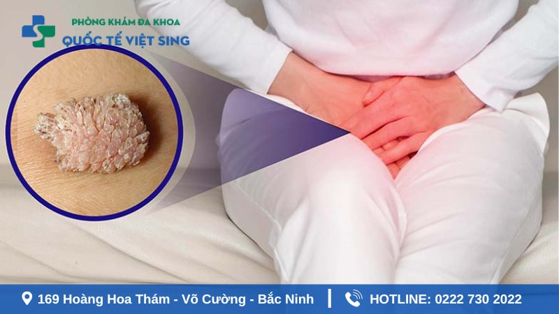 Bệnh sùi mào gà ở nữ giai đoạn đầu có nguy hiểm không?