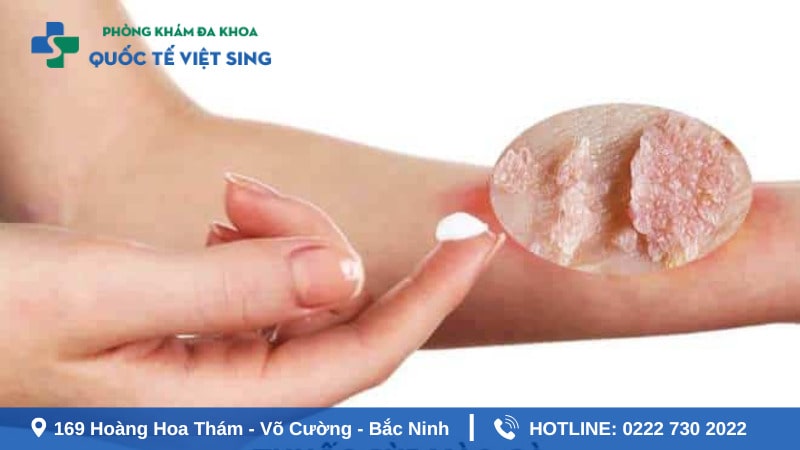 Sùi mào gà thường lây qua con đường nào?
