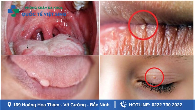 sùi mào gà giai đoạn đầu ở nam tại mặt miệng và họng
