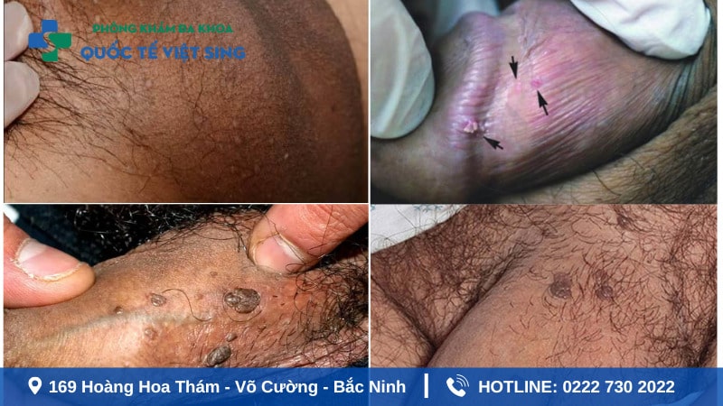 Sùi mào gà ở nam giới giai đoạn đầu tại vùng kín