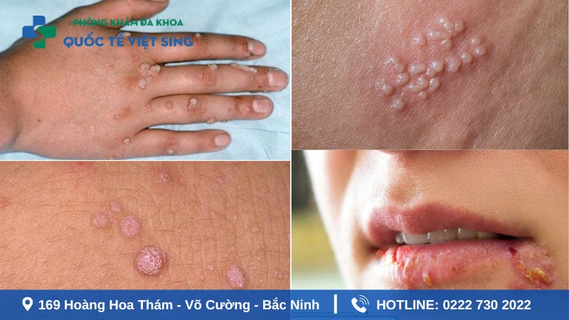Dấu hiệu súi mào gà xuất hiện tại các vị trí khác
