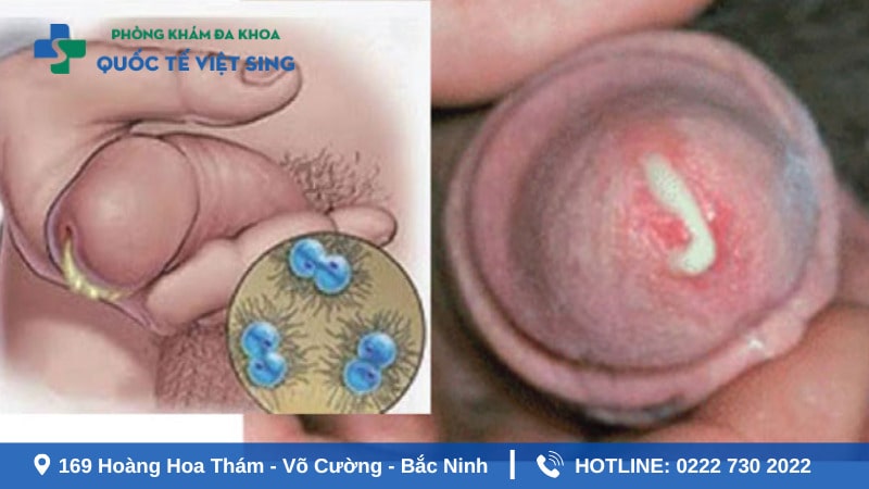 Tác hại của bệnh lậu đối với nam giới