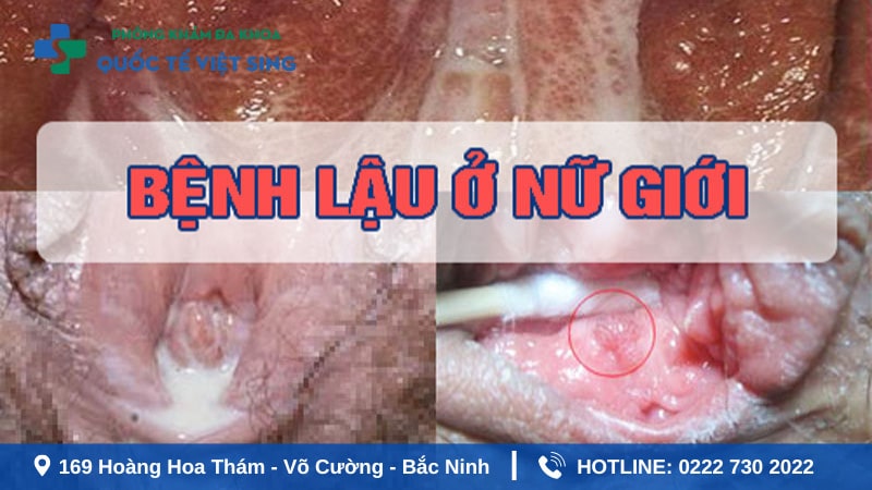 Tác hại của bệnh lậu đối với nữ giới