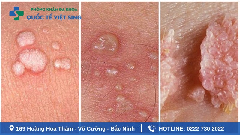 Thời gian ủ bệnh sùi mào gà là bao lâu ở nam và nữ