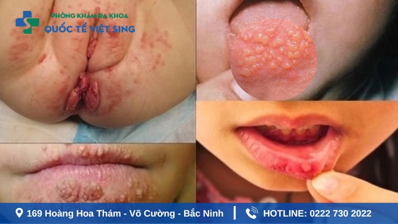 Hình ảnh sùi mào gà ở trẻ em tại miện, lưỡi và hậu môn