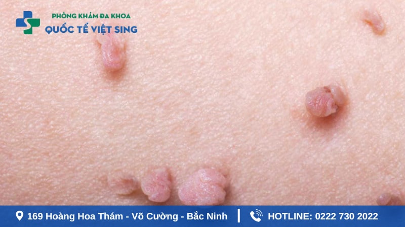 Bệnh sùi mào gà nguyên nhân do virus HPV gây ra