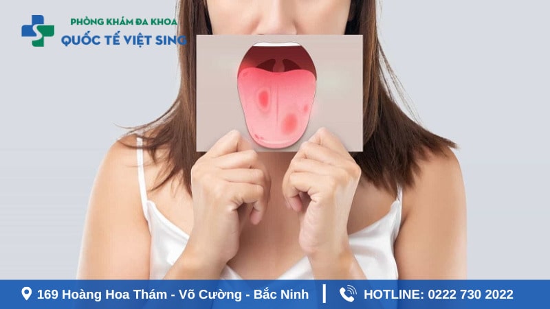 Sùi mào gà thường mặc ở 20 – 30 tuổi