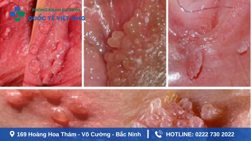 Bệnh sùi mào gà ở nữ có nguy hiểm không?