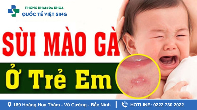 Có đến 10 – 20% trẻ em bị mụn cóc do sùi mào gà gây nên