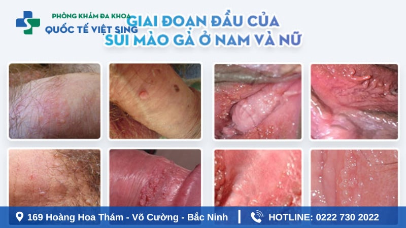 Sùi mào gà không điều trị kịp thời gây biến chứng nguy hiểm
