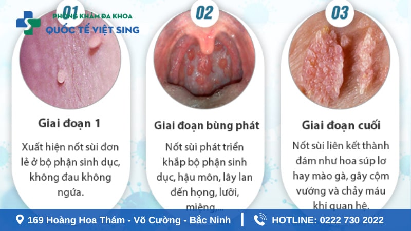 Các giai đoạn phát triển bệnh sùi mào gà ở nữ