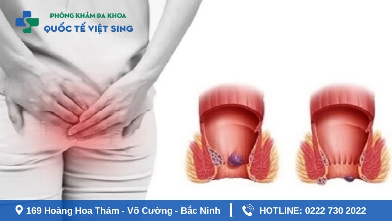 Các trường hợp cần đi khám hậu môn trực tràng