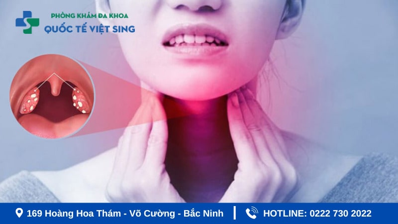 Cách điều trị sùi mào gà ở họng hiệu quả