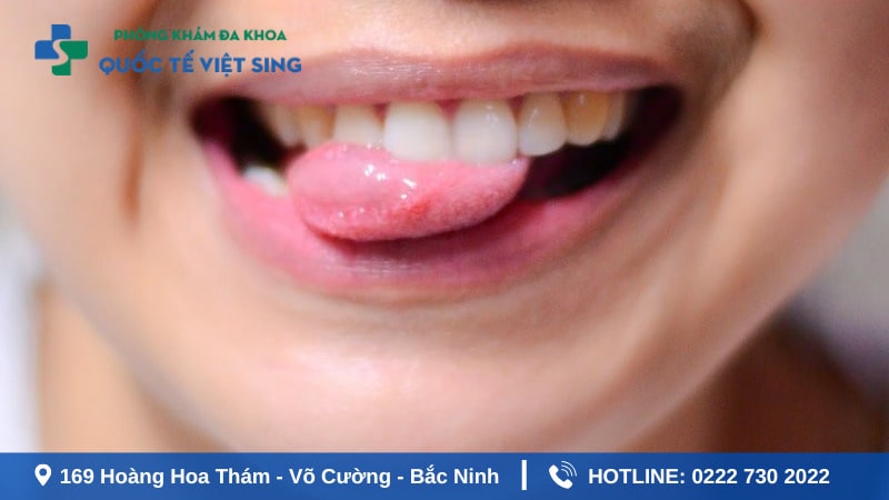 Sùi mào gà lây nhiễm chủ yếu qua đường tình dục